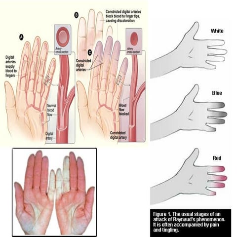 Raynaud's Disease presentation in detail