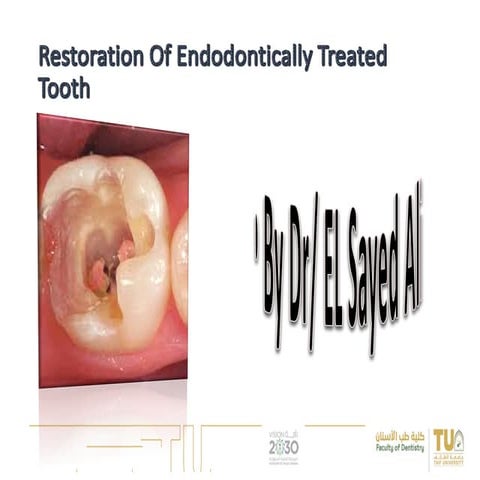 Restoration of the endodontically treated tooth | PPTX