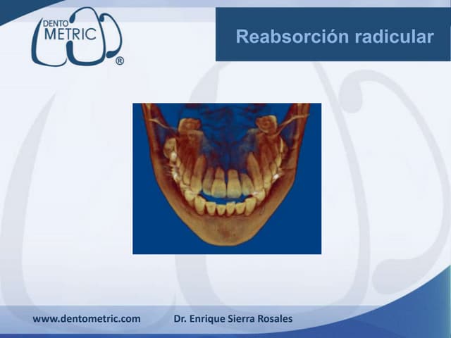 Reabsorcion radicular