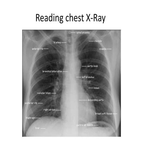 Reading chest x ray | PPTX