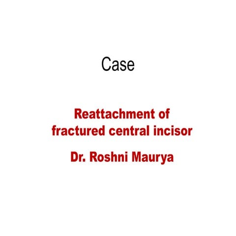 Reatthachemnt of fractured central incisor