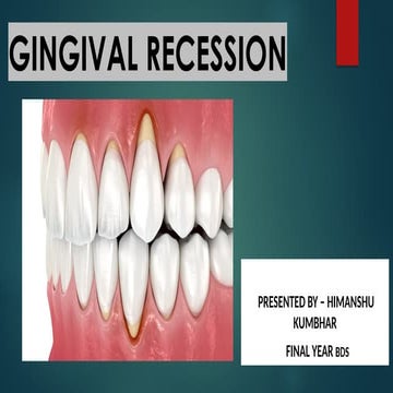 Gingival recession classifications | PPTX