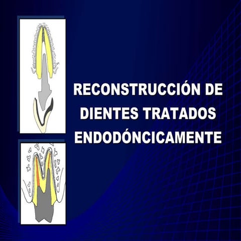 Reconstrucción dte tratado endodónticamente luz 2009