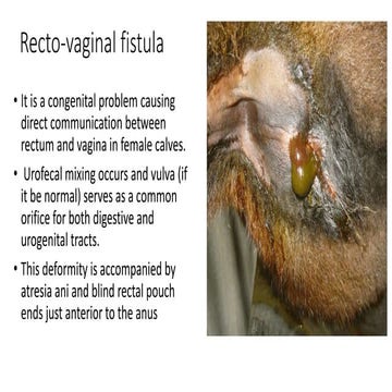 Rectovaginal fistula and correction.pptx
