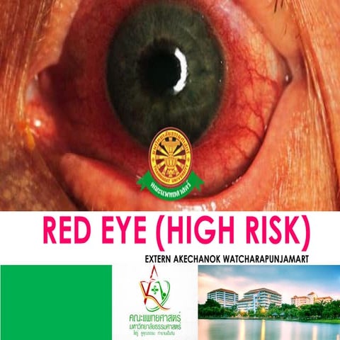 Red eye (high risk) by thann | PDF