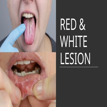 red & white disease of oral cavity......
