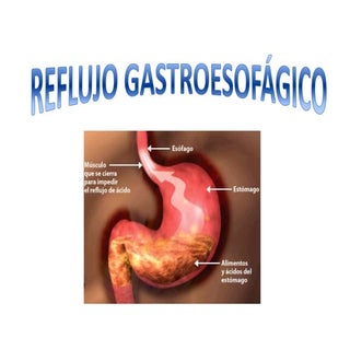 Reflujo gastroesofágico