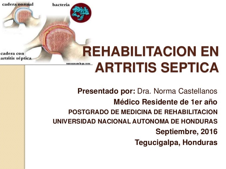 como+vivir+con+artritis+septica
