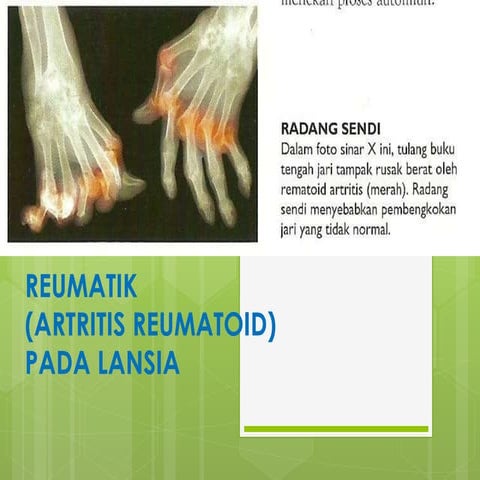 Rematoid arthritis shb