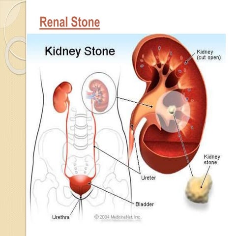 Renal stones