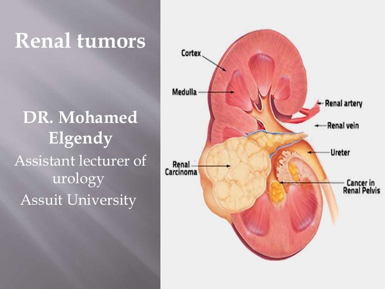 Renal tumor