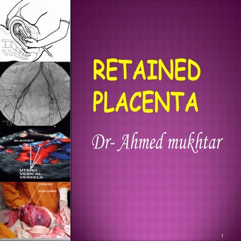 Ret placenta