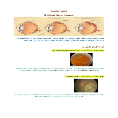 انفصال الشبكية.docx