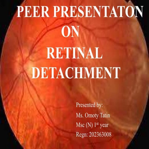 REtinal detachment.pptx