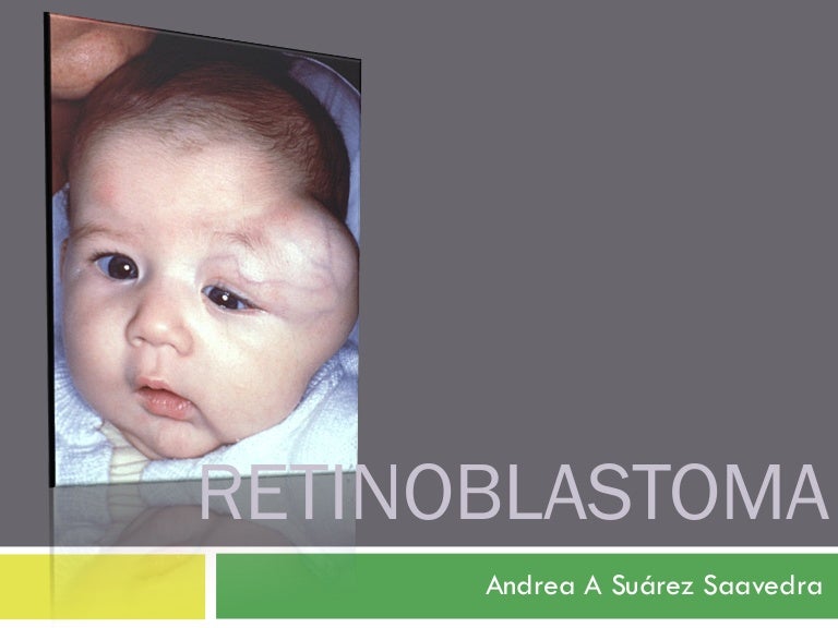 Retinoblastoma