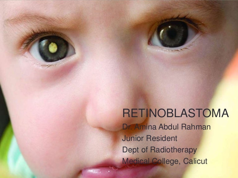 Retinoblastoma