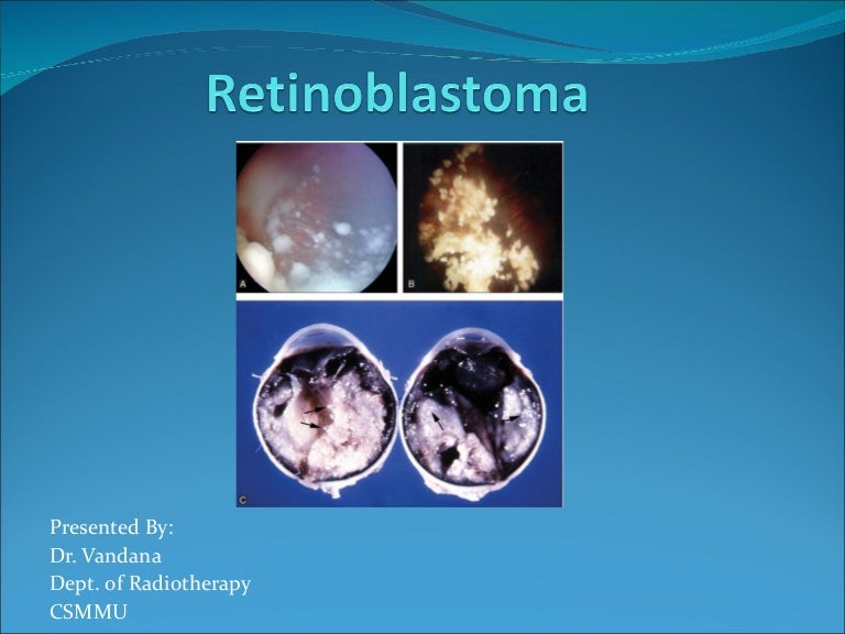 Retinoblastoma dr vandana