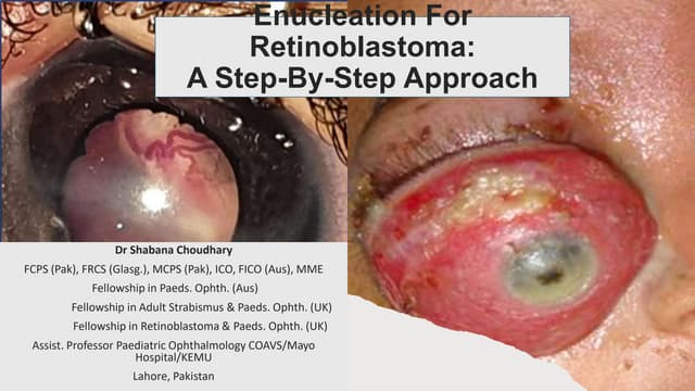 Enucleation and evisceration | PPTX