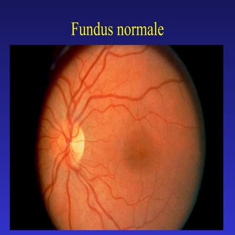 Retinopatia diabetica-omegna