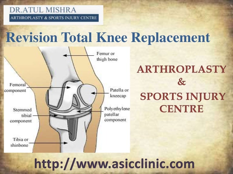 Revision knee replacement surgery