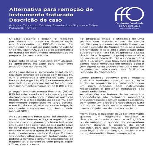 Alternativa para remoção de instrumento fraturado – Descrição de caso - FFO 