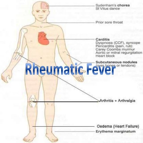Rheumatic Fever