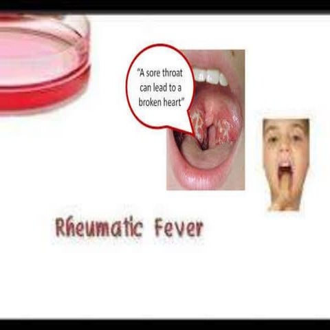 Rheumatic fever