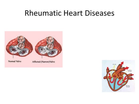 Confronting Rheumatic Heart Disease Perhaps The Spotlight Program: Confronting Rheumatic Heart Disease