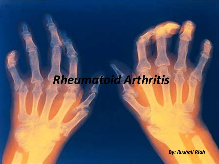 Rheumatoid arthritis introduction and case study
