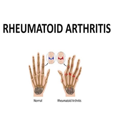Case presentation on Rheumatoid Arthritis | PPTX