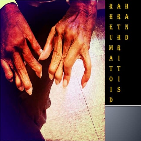 Rheumatoid arthritis   hand