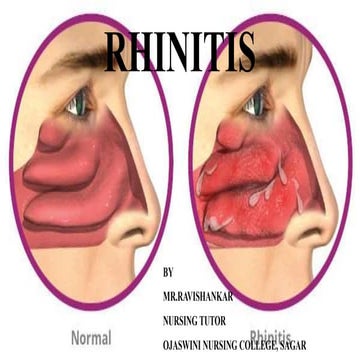 rhinitis.pdf