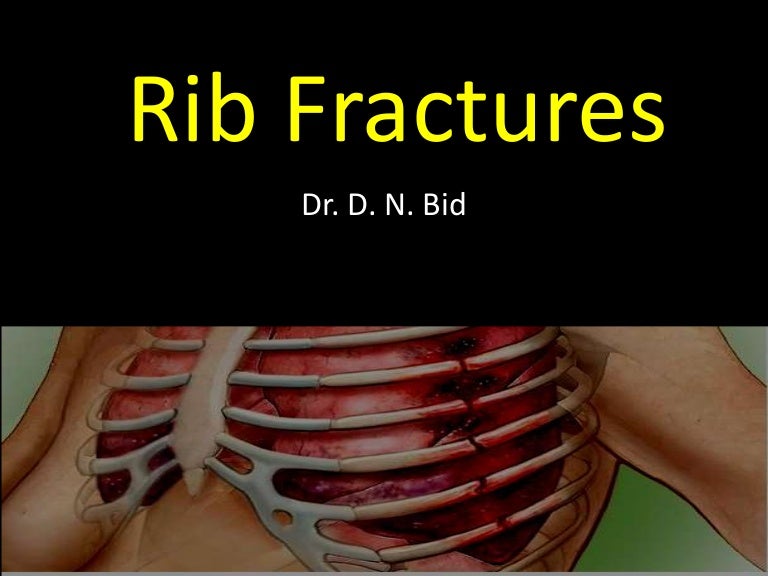 Rib fractures dnbid 2016