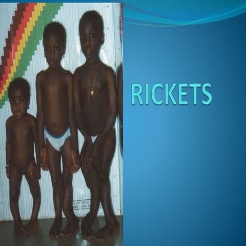 Rickets