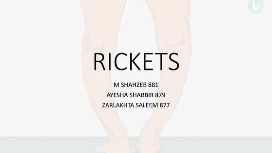 RICKETS : introduction, clinical features, Diagnosis, PT mangement | PPT