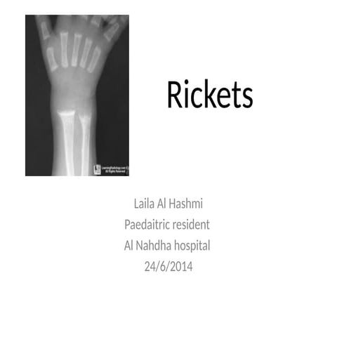 Rickets in children from diagnosis to treatment
