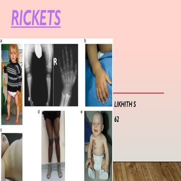 RICKETS.pptx calcium parathyroid hormone deficiency | PPT