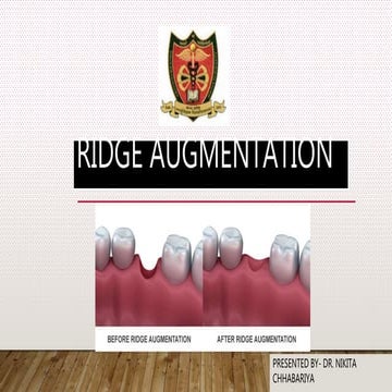 Ridge augmentation seminar