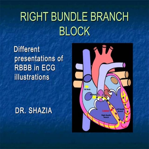 Right bundle branch block