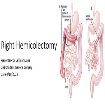 Right Hemicolectomy.pptx