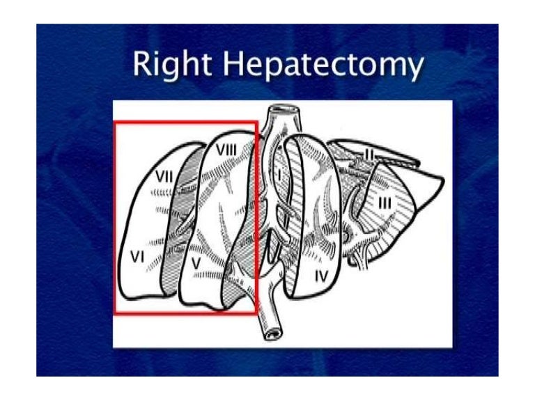 Right hepatectomy step by step description for surgeon.