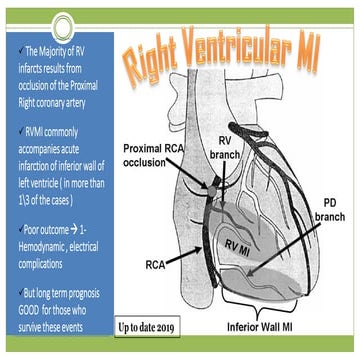 Right ventricular MI