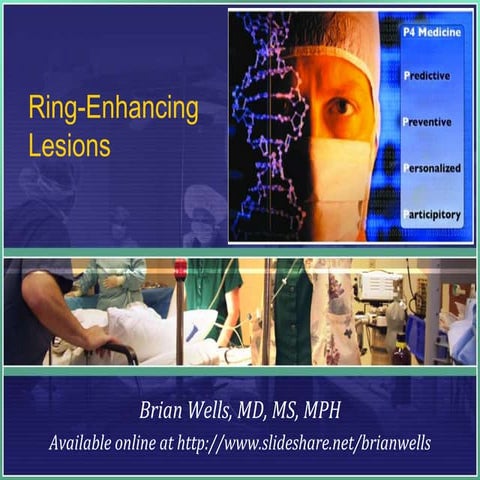Ring Enhancing Lesions