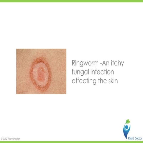 Ringworm