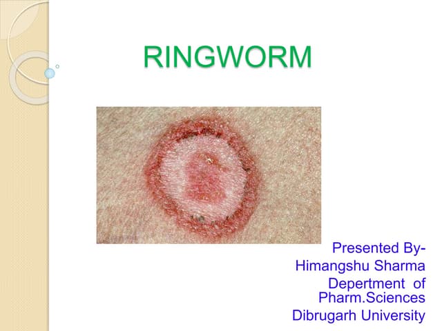 ringworm-150910162955-lva1-app6891-thumbnail.jpg