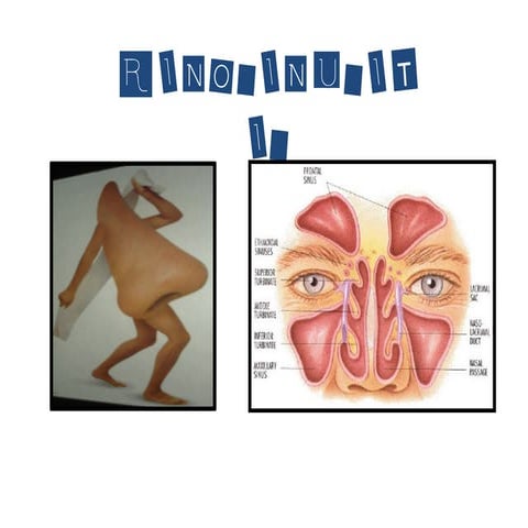 Rinosinusitis