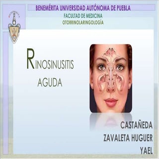 Rinosinusitis aguda 