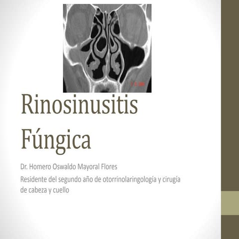 Rinosinusitis fúngica r2