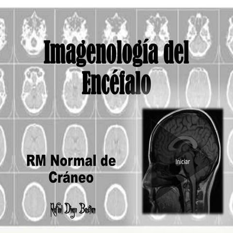 Rm Normal de cráneo