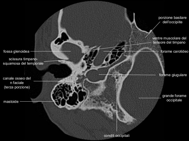Anatomia Rocca TC - CT temporal bone anatomy